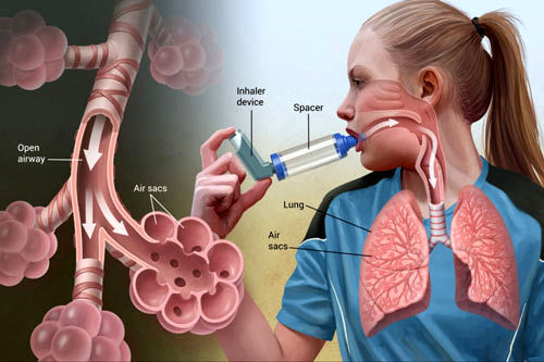 علل، علایم و راه های پیشگیری از  آسم