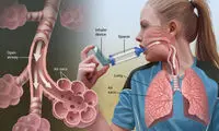 علل، علایم و راه های پیشگیری از  آسم
