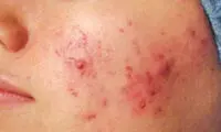 بیماری رزاسه و روش های مقابله با آن