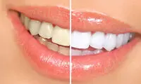 برای سفید کردن دندان‌هایتان، اصرار نکنید!