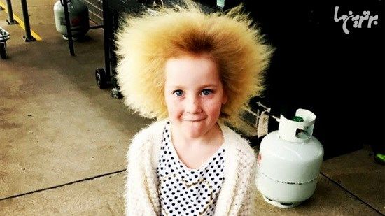 دختر ۷ ساله مبتلا به سندوم «موهای شانه نشدنی»