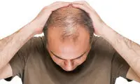 ۴ اسموتی برای مقابله با ریزش مو
