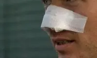 حرکت شوکه‌کننده مرد جوان برای عمل بینی در منزل!