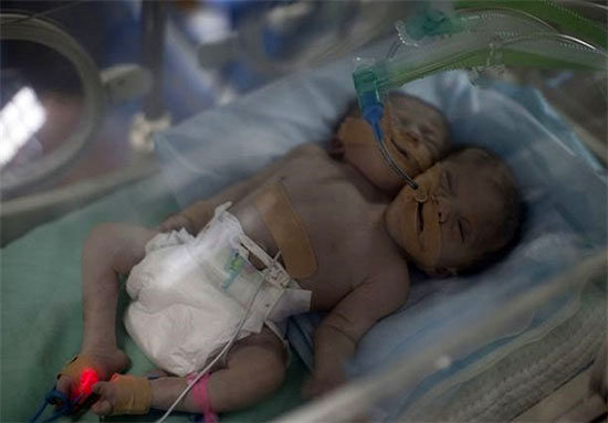 تولد نوزاد دو سر در غزه
