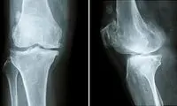 عوارض کمبود کلسیم برای بدن