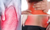 راهکار‌های طبیعی برای کاهش درد و التهاب عضلات