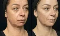 هایفوتراپی چیست؟ کاربرد، ماندگاری، مزایا و هزینه