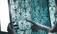 درمان جدیدی که می‌تواند به توقف آلزایمر کمک کند