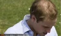 شيوه جديد بيدار كردن موی افراد كچل!