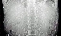 ده ها کِرم در بدن مرد امریکایی +عکس