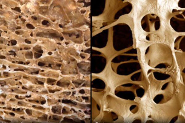 تشخیص پوکی استخوان از روی تراشه‌های ناخن