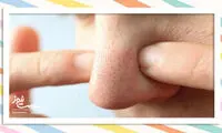 چگونه از شر جوش‌های سر سیاه خلاص شویم؟