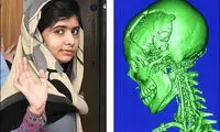 بازسازی جمجمه دختر 15 ساله +عکس