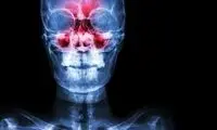تغییر سلولی، عامل ابتلا به سینوزیت مزمن است