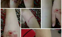 حمله سگ ولگرد به یک کودک ۷ ساله