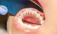 علائم شایع سرطان دهان