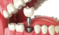طول عمر انواع ایمپلنت چقدر است؟