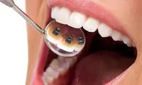 انواع مدل های ارتودنسی نامرئی و هزینه آن